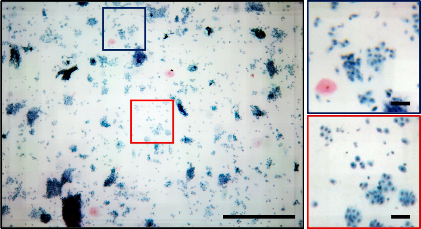 Color FP reconstruction of a Pap smear from the smartphone microscope, with zoomed regions.